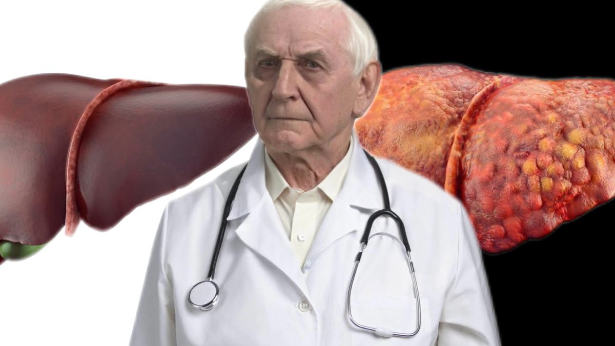 Как распознать цирроз печени: 7 тревожных сигналов организма